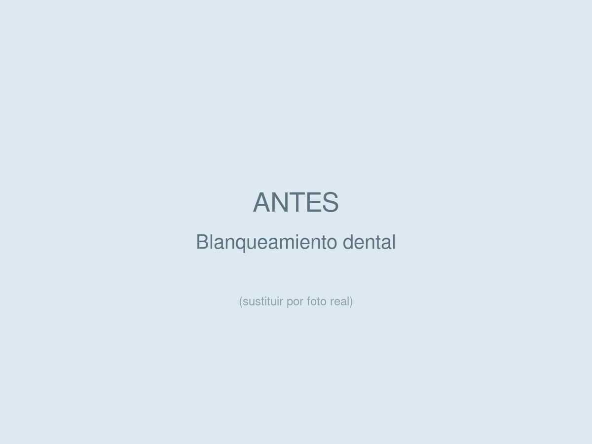 Blanqueamiento Dental, antes