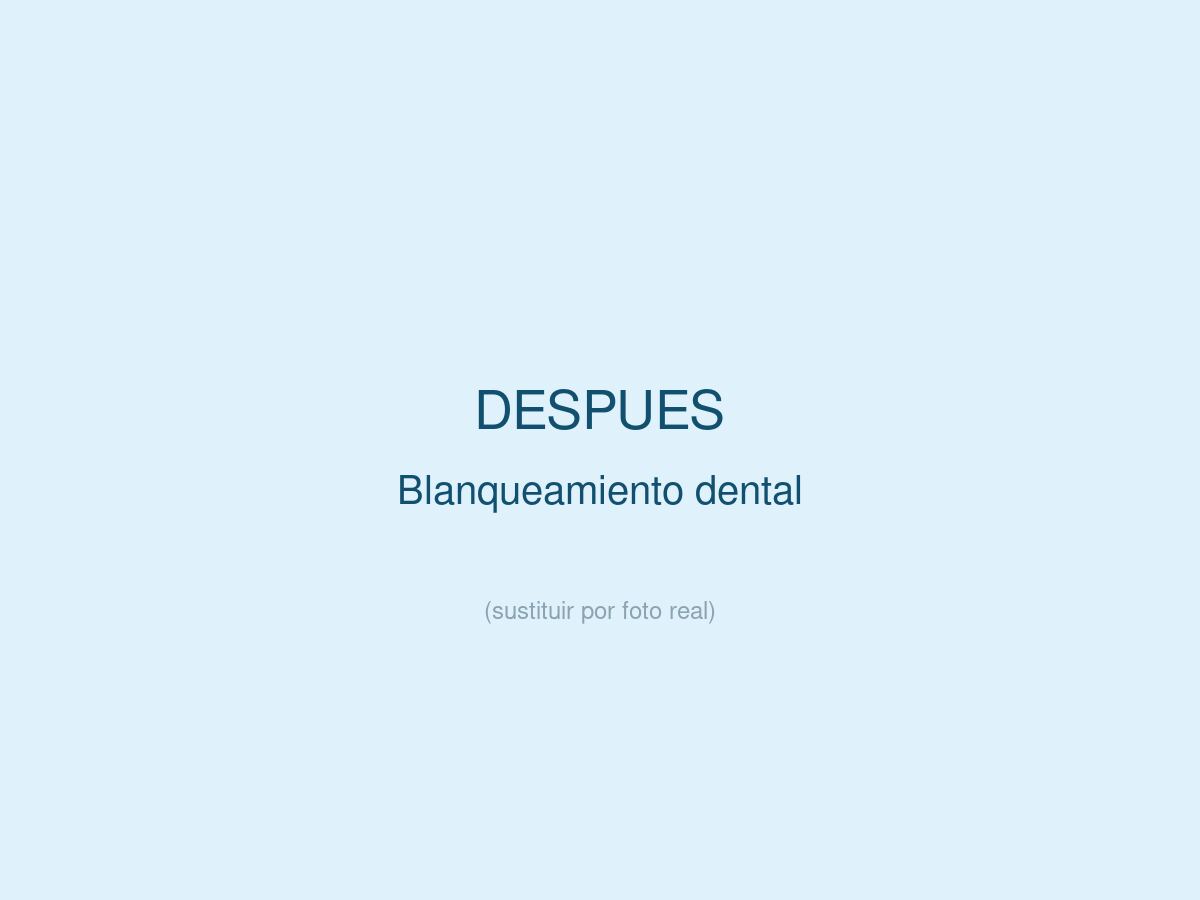 Blanqueamiento Dental, despu&eacute;s