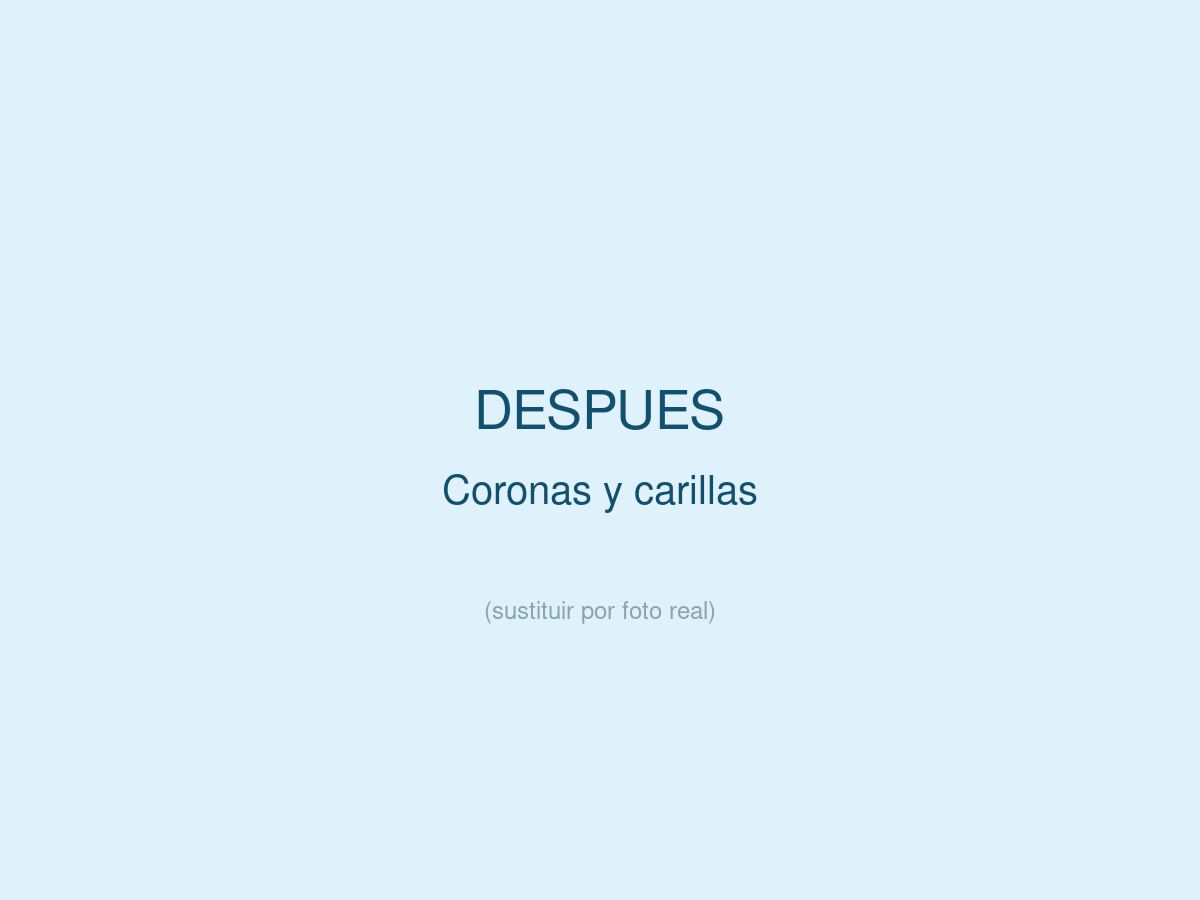 Coronas y Carillas, despu&eacute;s