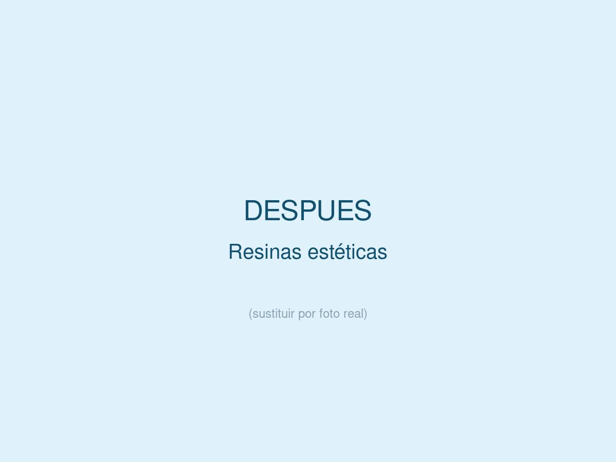 Resinas Est&eacute;ticas, despu&eacute;s
